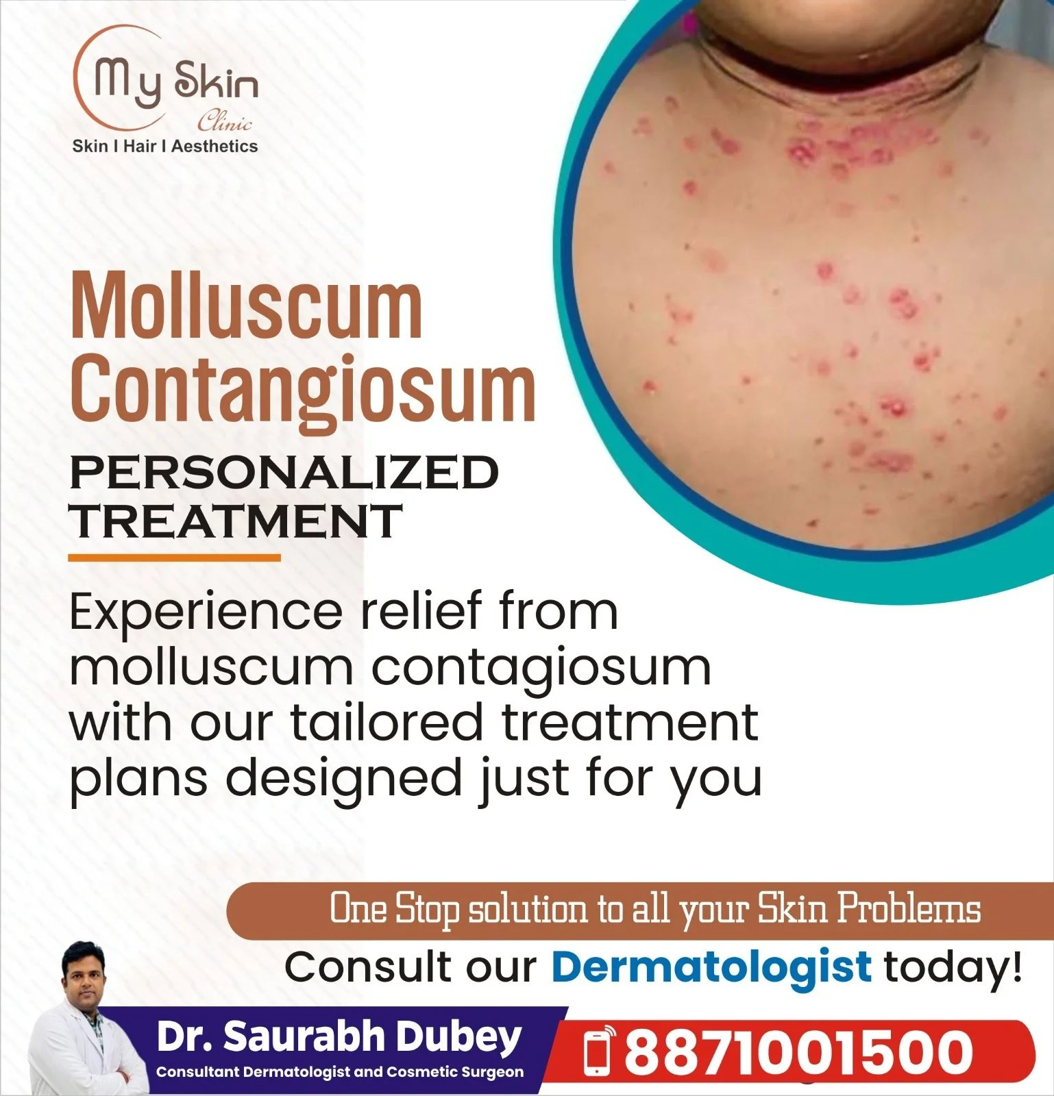 Molluscum Contagiosum Treatment in Indore